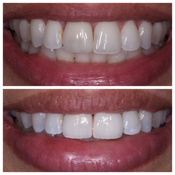 Before/After Gallery Gentle Dental Bayside, New York