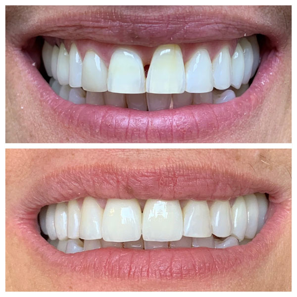 Before/After Gallery Gentle Dental Bayside, New York