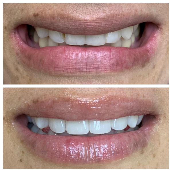 Before/After Gallery Gentle Dental Bayside, New York