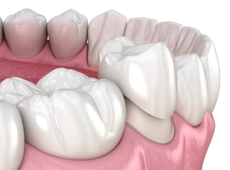 Dental Crowns